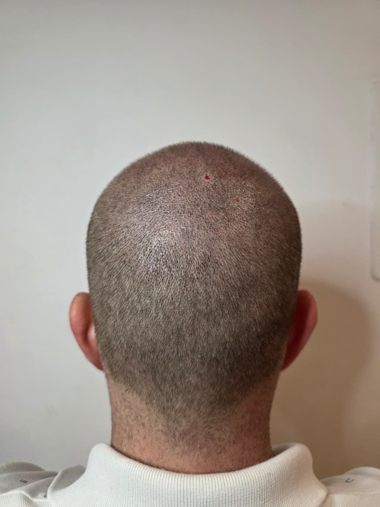 Después: Densificación