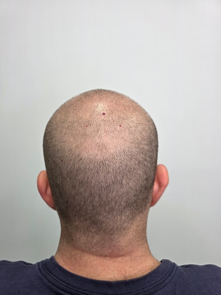 Antes: Densificación